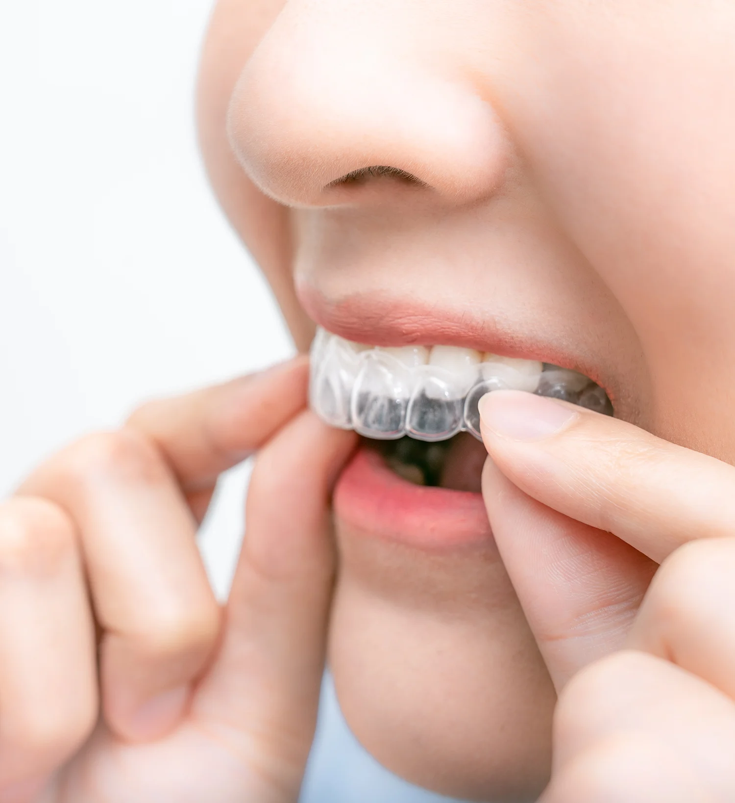 Usynlig tannregulering | Sorrisi
