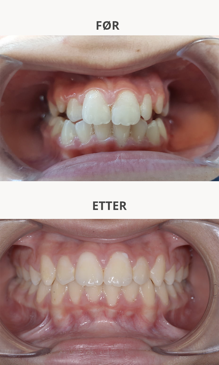 Før og etter Før og etter | Sorrisi